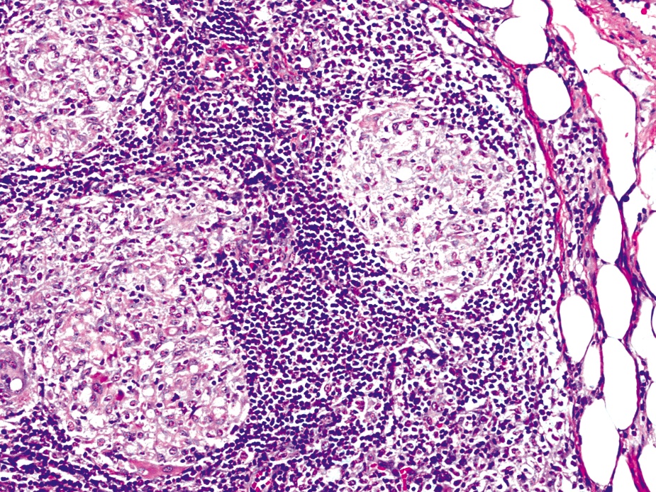 Pathology Outlines Sarcoidosis 